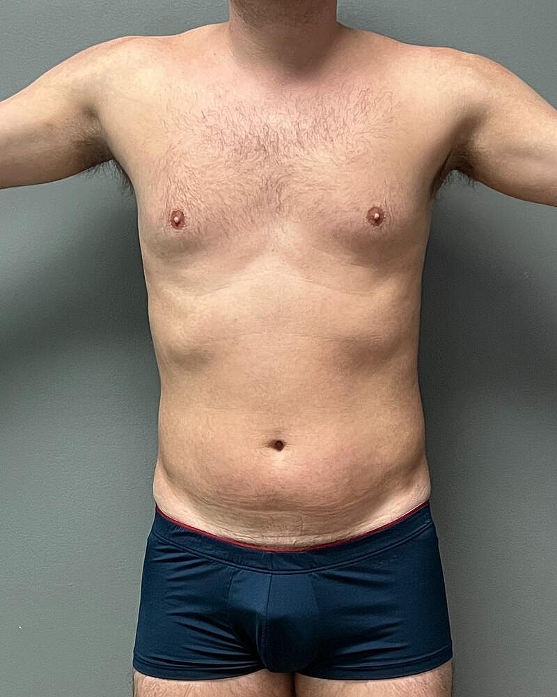 Liposuction Before & After