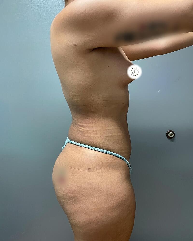 Liposuction Before & After
