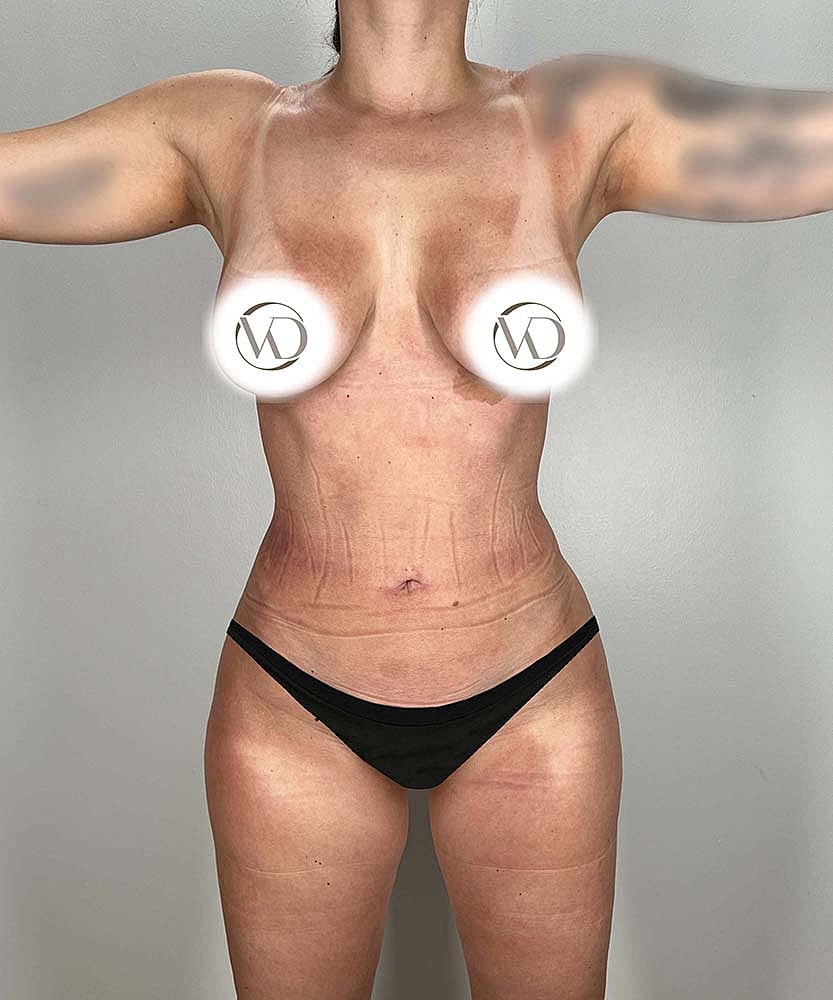 Liposuction Before & After