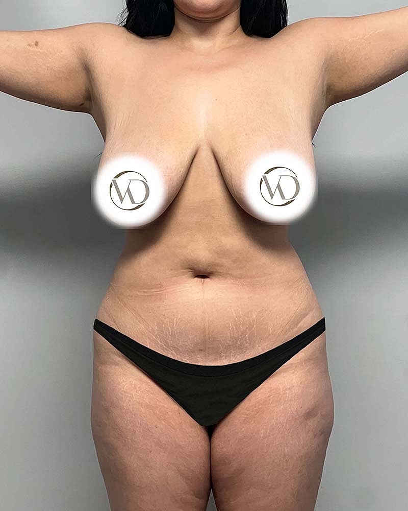 Liposuction Before & After