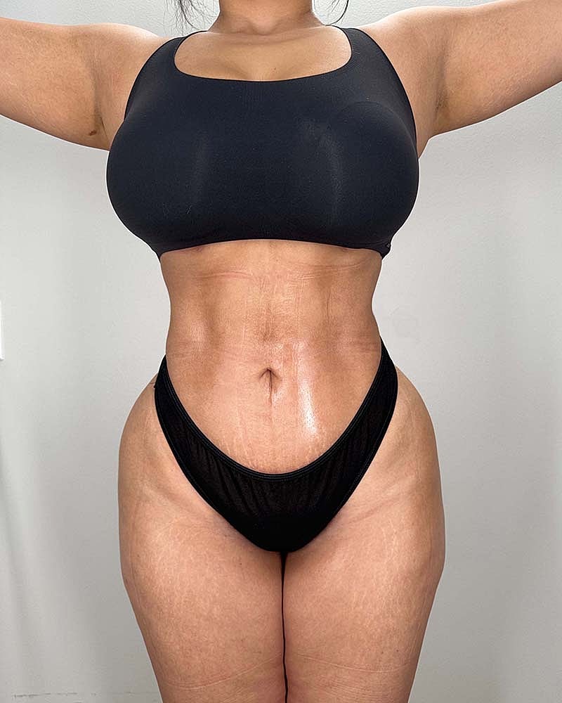 Liposuction Before & After