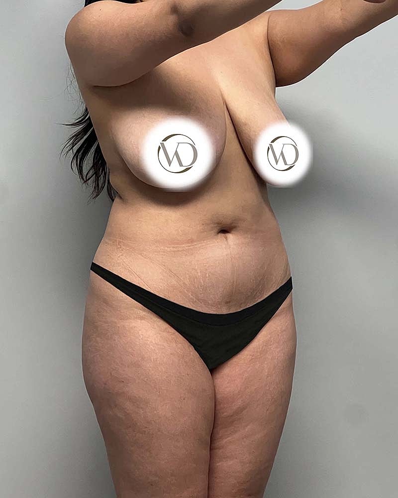 Liposuction Before & After