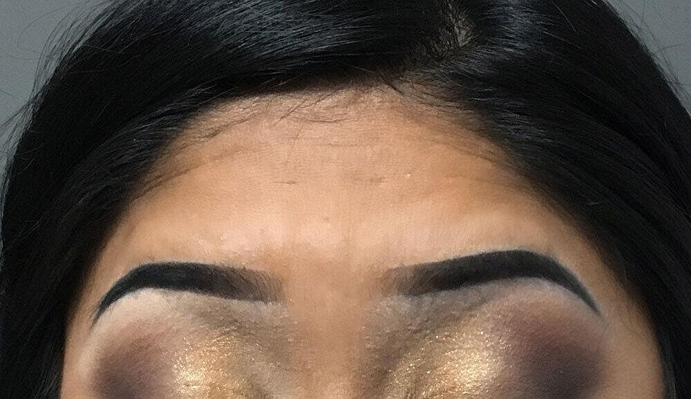 Botox Before & After