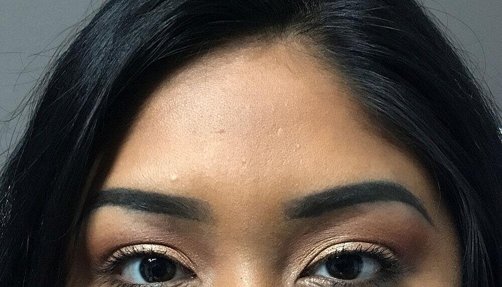 Botox Before & After