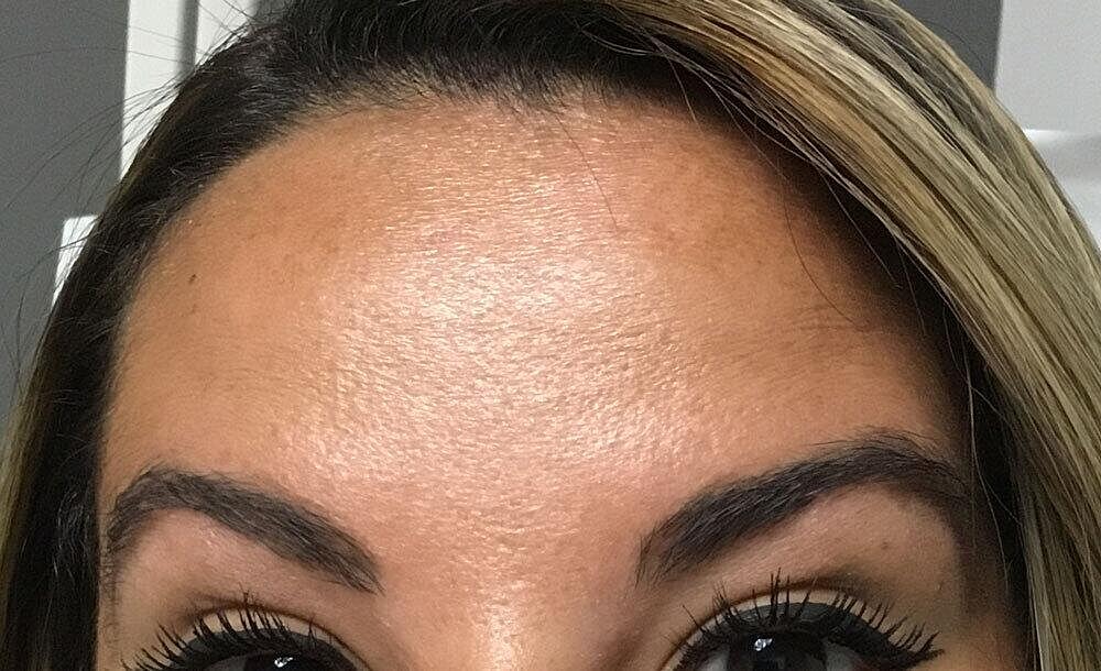 Botox Before & After