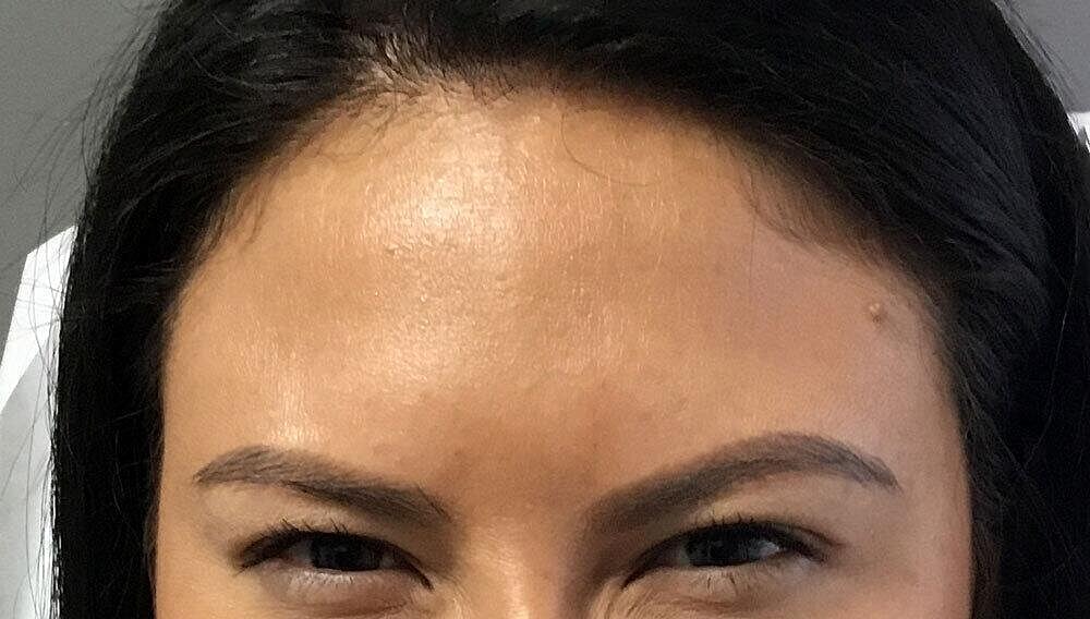 Botox Before & After