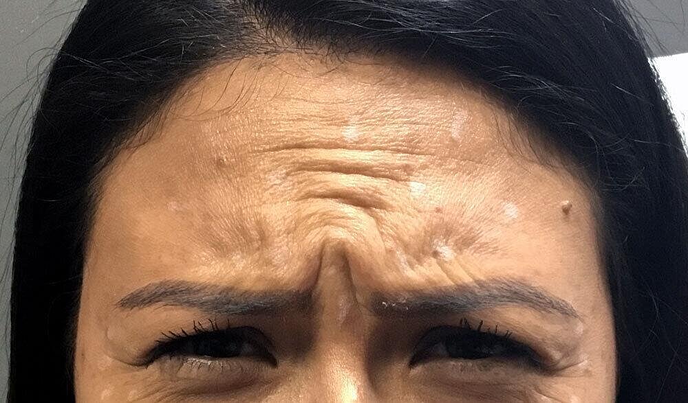 Botox Before & After