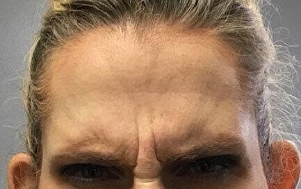 Botox Before & After