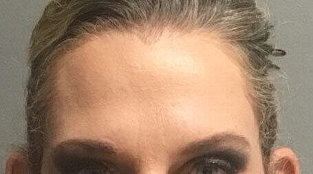 Botox Before & After