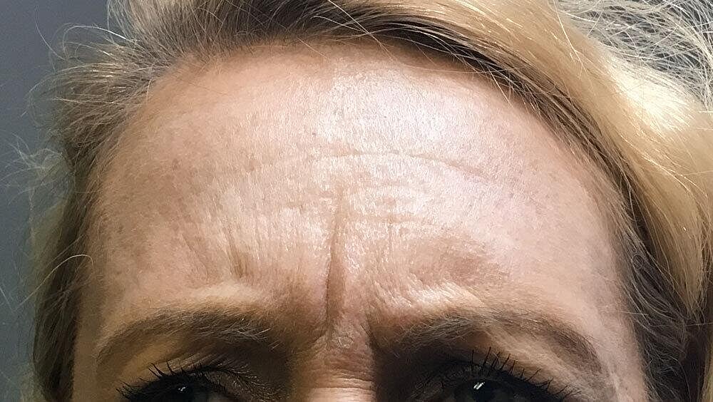 Botox Before & After