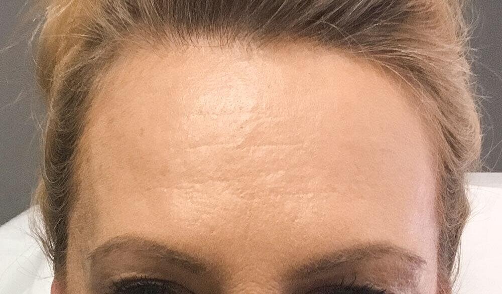Botox Before & After
