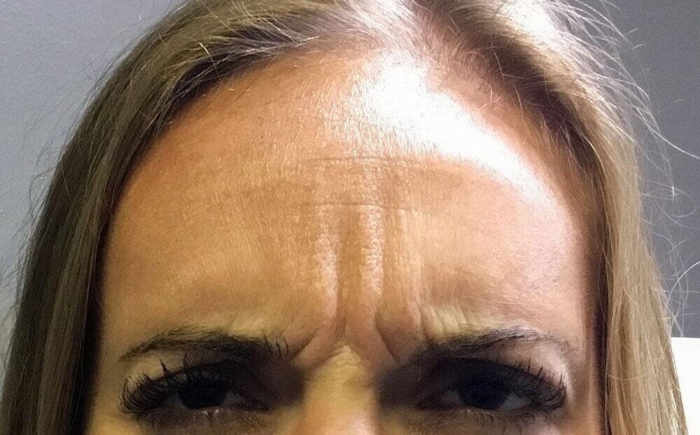 Botox Before & After