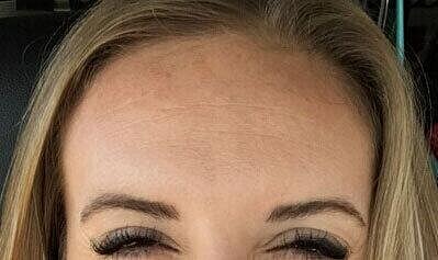 Botox Before & After