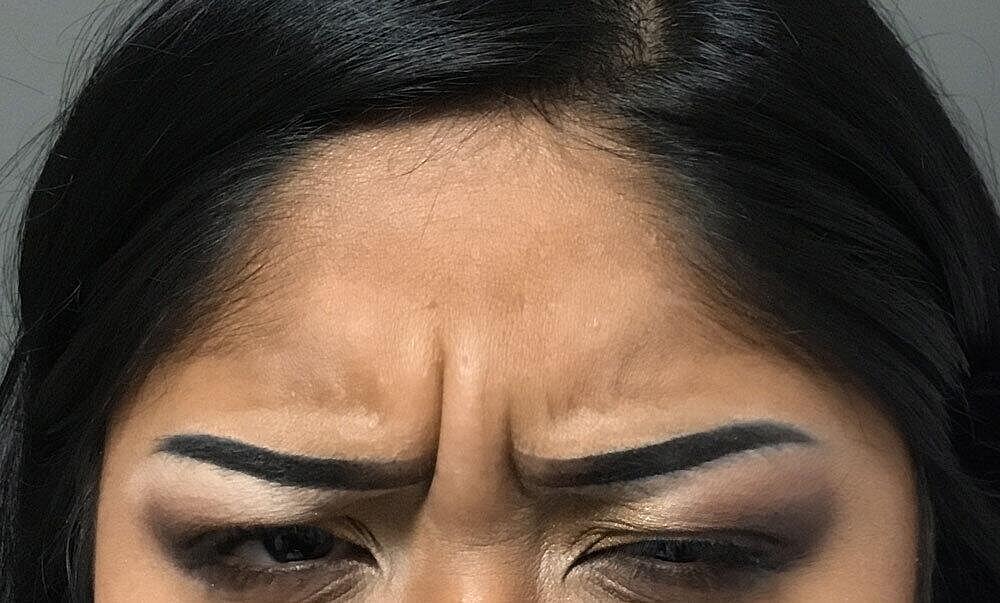 Botox Before & After