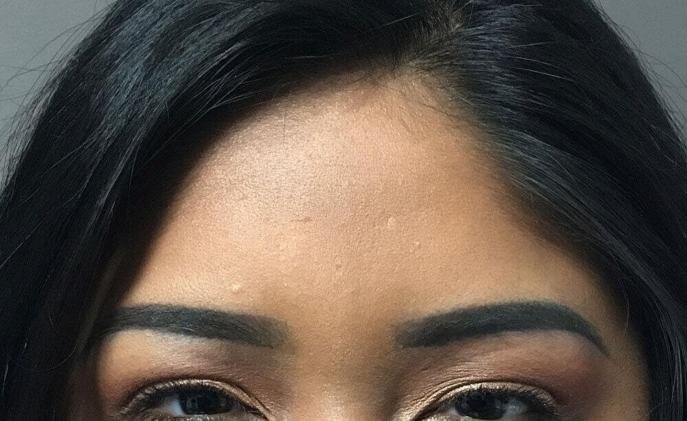 Botox Before & After