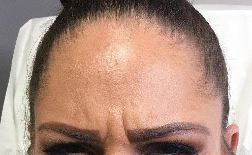 Botox Before & After