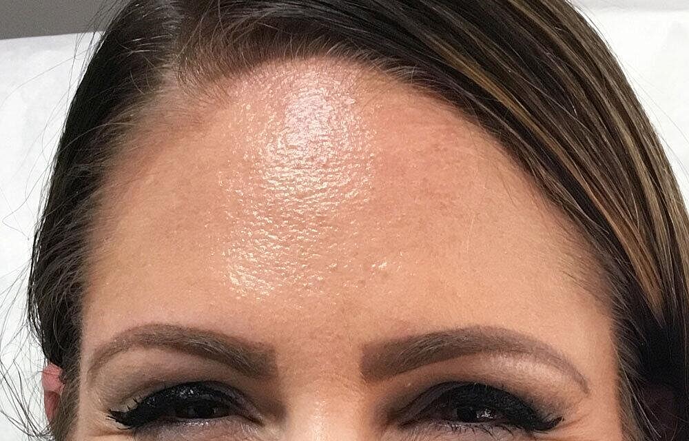 Botox Before & After