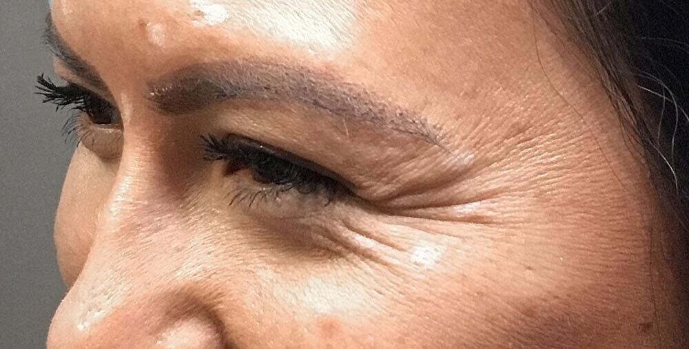 Botox Before & After