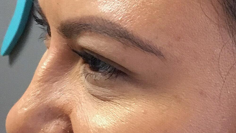 Botox Before & After