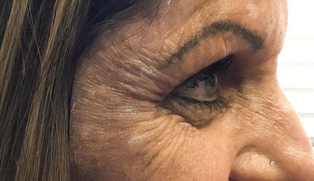 Botox Before & After