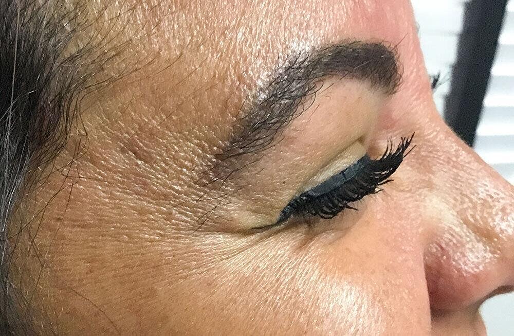 Botox Before & After
