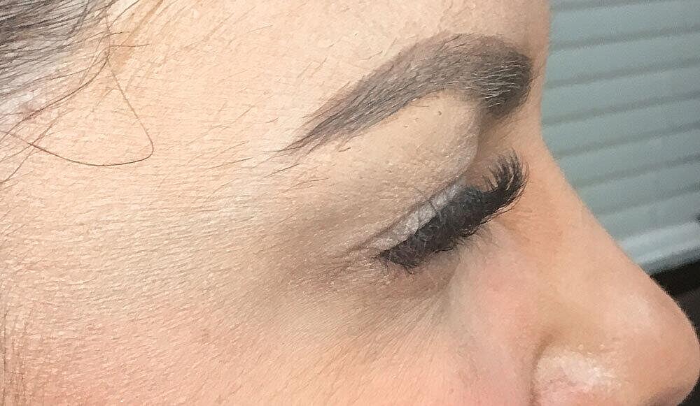 Botox Before & After