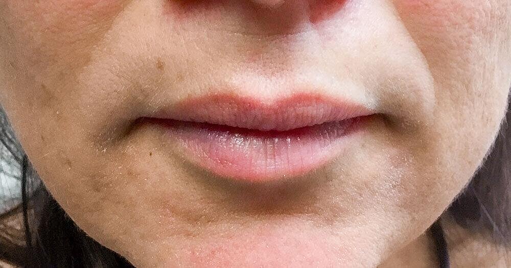 Botox Before & After