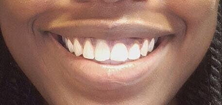 Botox Before & After