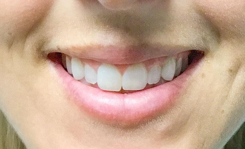 Botox Before & After