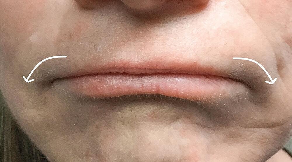 Botox Before & After