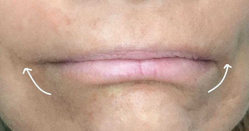 Botox Before & After