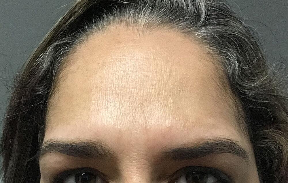 Botox Before & After