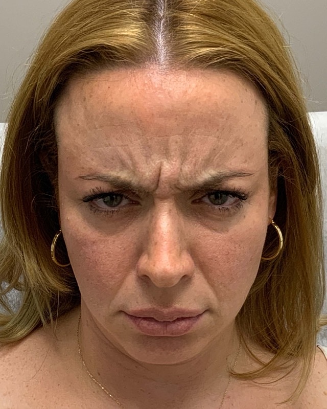 Botox Before & After