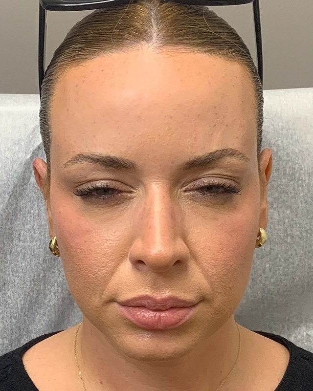 Botox Before & After