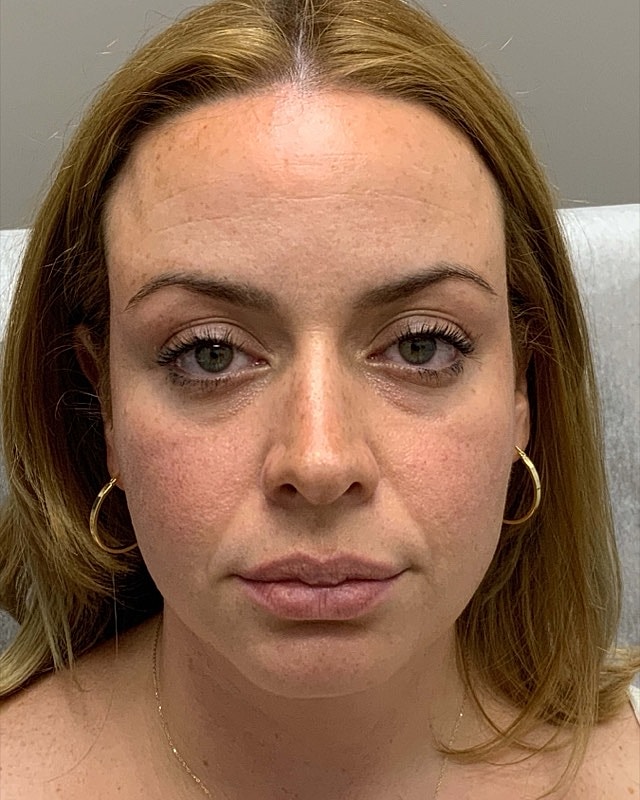 Botox Before & After