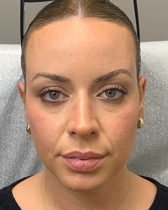 Botox Before & After