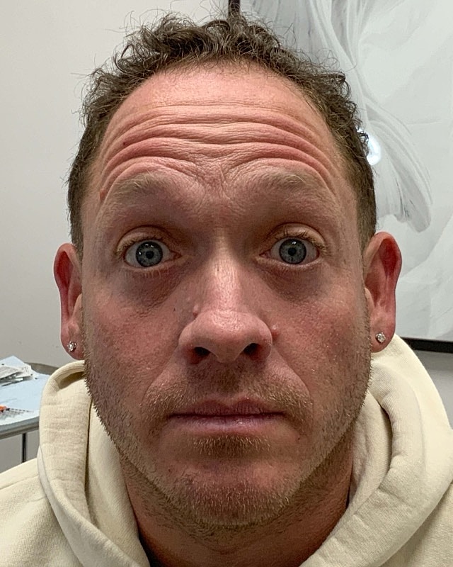 Botox Before & After
