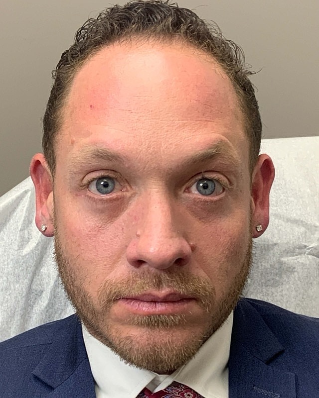 Botox Before & After
