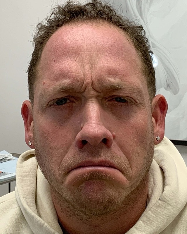Botox Before & After