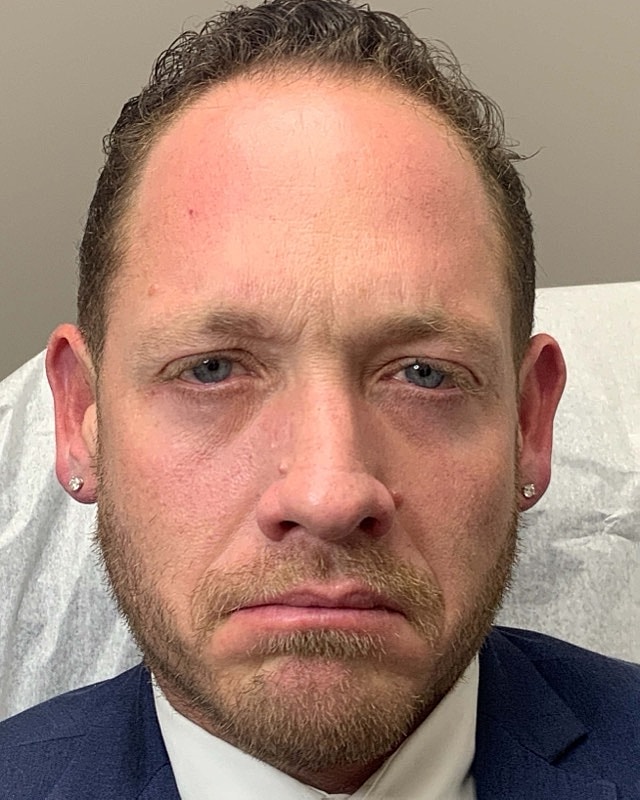 Botox Before & After