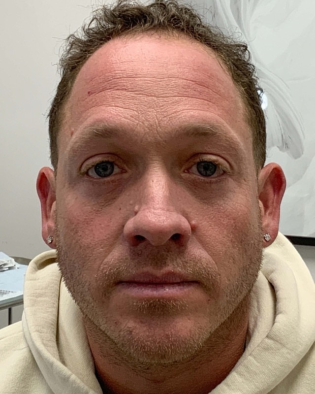 Botox Before & After