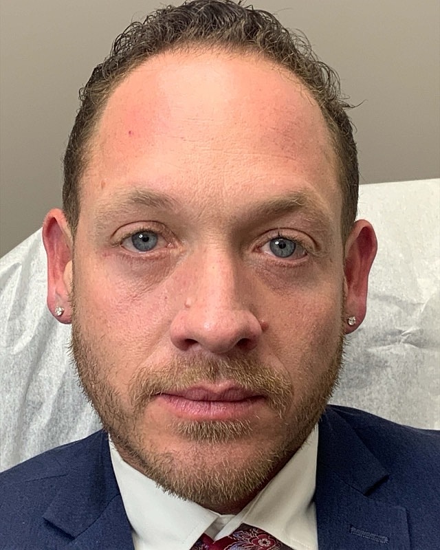 Botox Before & After