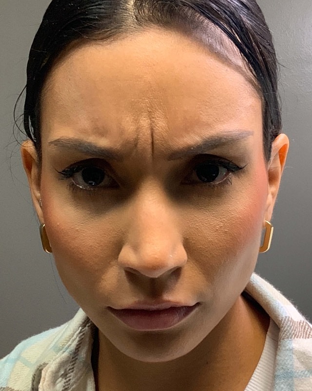 Botox Before & After