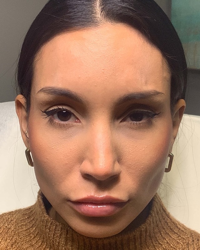 Botox Before & After