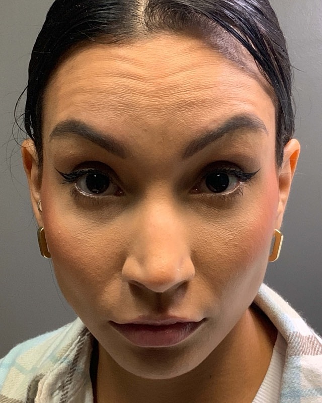 Botox Before & After