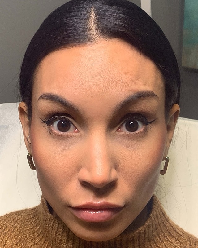 Botox Before & After