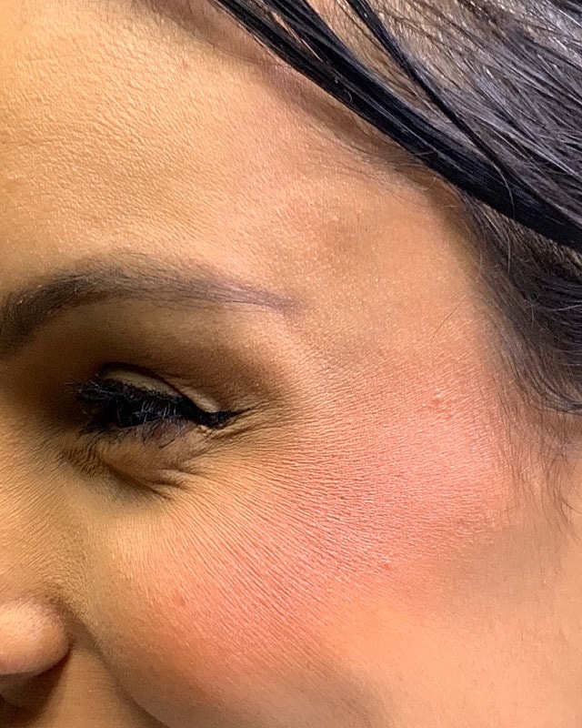 Botox Before & After