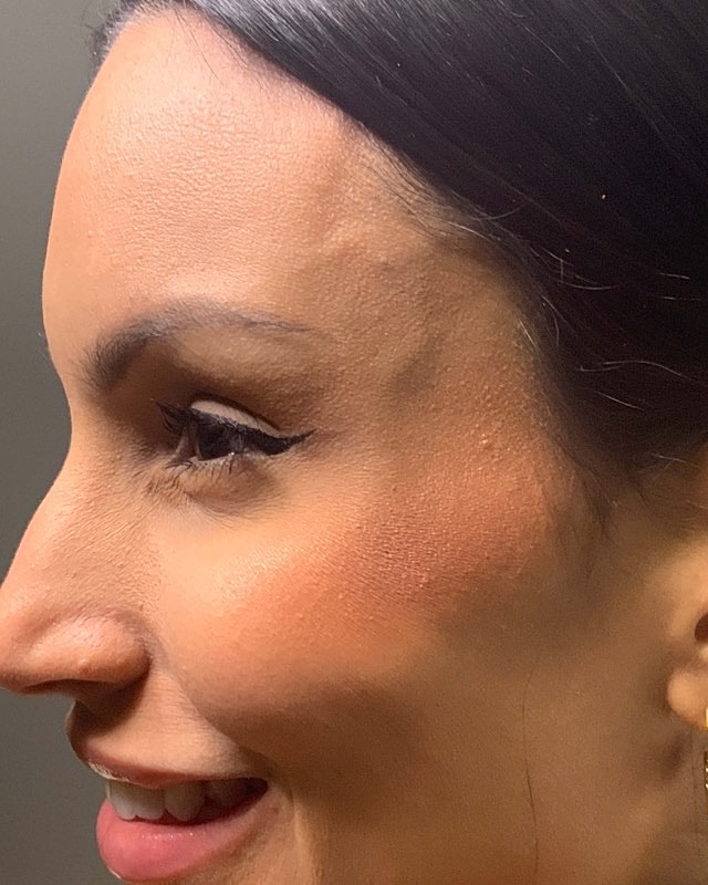 Botox Before & After
