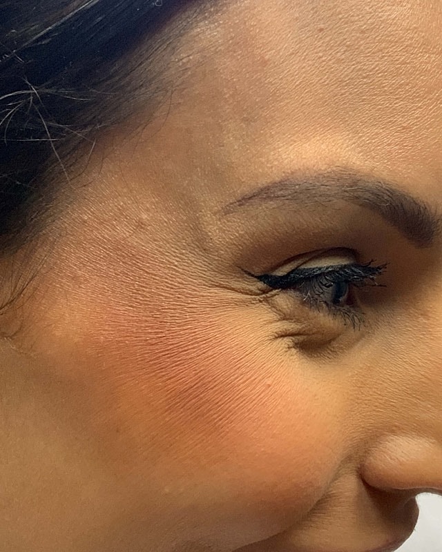 Botox Before & After