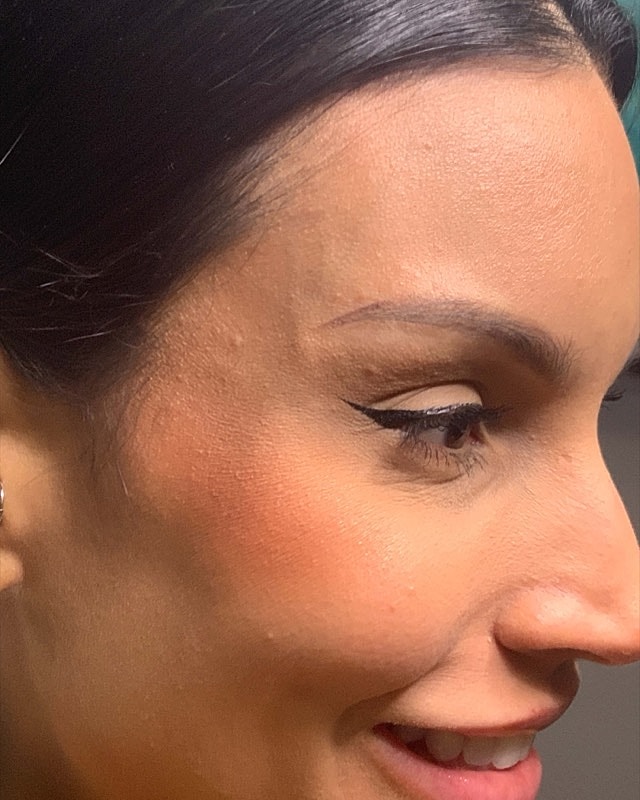 Botox Before & After
